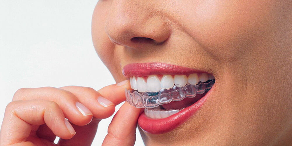 Капа для зубів: новий метод зробити вашу посмішку неперевершеною
